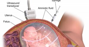 Amniocentese: o que é e como é feito esse teste diagnóstico


