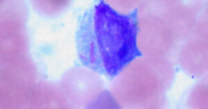 Leucoblastos: o que são e como se relacionam com outras células leucêmicas