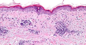 Lúpus eritematoso sistêmico: o que é, características e sintomas