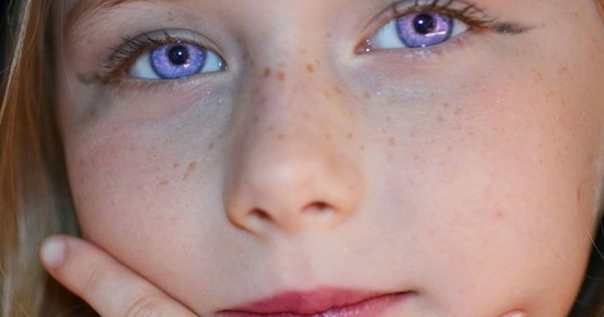 Síndrome de Alexandria: a "doença rara" dos olhos roxos