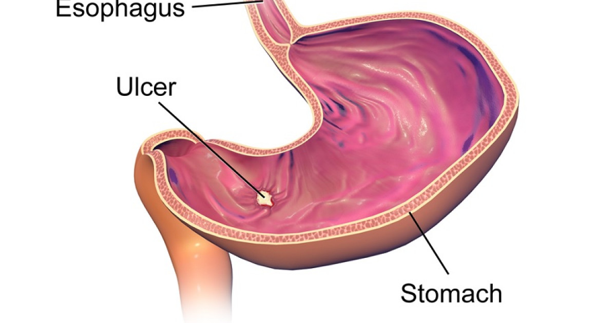 Tipos de úlceras: características, causas e perigos que apresentam