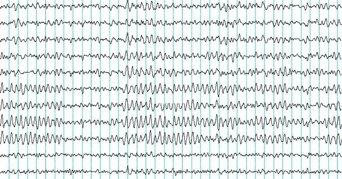 Eletroencefalograma (EEG): o que é e como se utiliza?