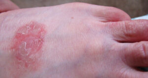 Manchas vermelhas na pele: 25 possíveis doenças e sintomas causais