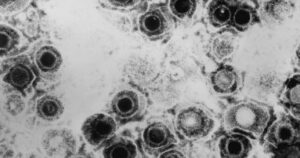Os 8 tipos de herpes: características e doenças associadas